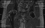 Рис. 3. Зображення зважене за часом релаксації Т1 з пригніченням сигналу від жирової тканини (відстрочене сканування) – МР-артрограма.